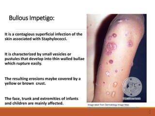 Bullous Impetigo:
It is a contagious superficial infection of the
skin associated with Staphylococci.
It is characterized by small vesicles or
pustules that develop into thin walled bullae
which rupture easily.
The resulting erosions maybe covered by a
yellow or brown crust.
The face, trunk and extremities of infants
and children are mainly affected.
2
2
Image taken from Dermatology Image Atlas
http://www.dermis.net/dermisroot/en/27080/image.htm
 