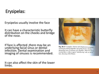 Erysipelas:
Erysipelas usually involve the face
It can have a characteristic butterfly
distribution on the cheeks and bridge
of the nose.
If face is affected ,there may be an
underlying facial sinus or dental
infection. Dental examination and
imaging of sinuses is recommended.
It can also affect the skin of the lower
limbs.
28
 