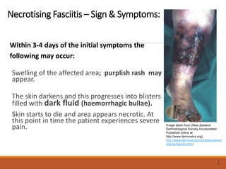 Necrotising Fasciitis – Sign & Symptoms:
Within 3-4 days of the initial symptoms the
following may occur:
Swelling of the affected area; purplish rash may
appear.
The skin darkens and this progresses into blisters
filled with dark fluid (haemorrhagic bullae).
Skin starts to die and area appears necrotic. At
this point in time the patient experiences severe
pain.
5
0
Image taken from (New Zealand
Dermatological Society Incorporated.
Published online at:
http://www.dermnetnz.org).
http://www.dermnet.org.nz/bacterial/necr
otising-fasciitis.html
 