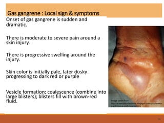 Gas gangrene : Local sign & symptoms
Onset of gas gangrene is sudden and
dramatic.
There is moderate to severe pain around a
skin injury.
There is progressive swelling around the
injury.
Skin color is initially pale, later dusky
progressing to dark red or purple
Vesicle formation; coalescence (combine into
large blisters); blisters fill with brown-red
fluid.
59
Image taken from
http://anaerobicinfections.blogspot.com/p/cutaneou
s-soft-tissue-and-muscle.html
 