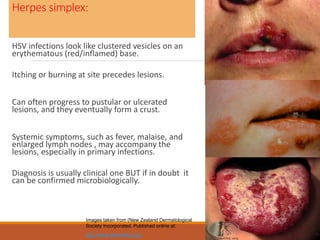 Herpes simplex:
HSV infections look like clustered vesicles on an
erythematous (red/inflamed) base.
Itching or burning at site precedes lesions.
Can often progress to pustular or ulcerated
lesions, and they eventually form a crust.
Systemic symptoms, such as fever, malaise, and
enlarged lymph nodes , may accompany the
lesions, especially in primary infections.
Diagnosis is usually clinical one BUT if in doubt it
can be confirmed microbiologically.
68
Images taken from (New Zealand Dermatological
Society Incorporated. Published online at:
http://www.dermnetnz.org
 