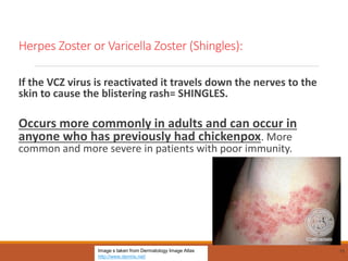 Herpes Zoster or Varicella Zoster (Shingles):
If the VCZ virus is reactivated it travels down the nerves to the
skin to cause the blistering rash= SHINGLES.
Occurs more commonly in adults and can occur in
anyone who has previously had chickenpox. More
common and more severe in patients with poor immunity.
75
Image s taken from Dermatology Image Atlas
http://www.dermis.net/
 