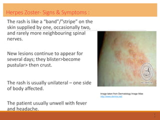 Herpes Zoster- Signs & Symptoms :
The rash is like a “band”/”stripe” on the
skin supplied by one, occasionally two,
and rarely more neighbouring spinal
nerves.
New lesions continue to appear for
several days; they blister>become
pustular> then crust.
The rash is usually unilateral – one side
of body affected.
The patient usually unwell with fever
and headache.
7
7
Image taken from Dermatology Image Atlas
http://www.dermis.net/
 