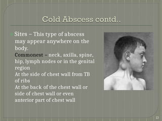Comprehensive Overview of Staphylococcal and Streptococcal Abscesses ...