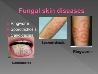  Ringworm
 Sporotrichosis
 Candidacies
 