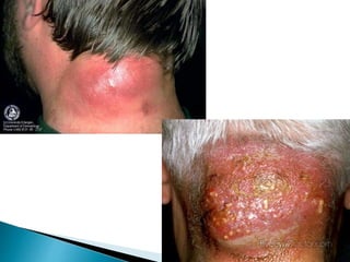 Skin infections | PPT