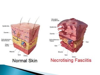 Decayed Skin Skin infections | PPT