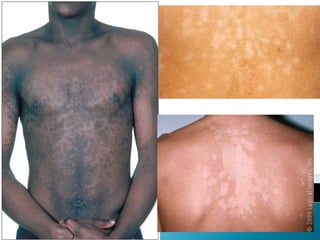 Skin infections | PPT