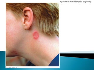 Skin infections | PPT