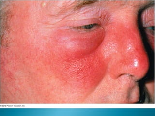 Skin infections | PPT