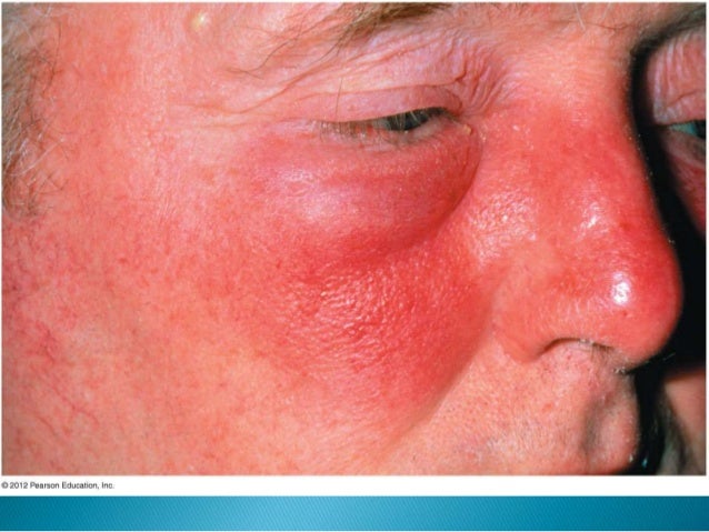 Skin Infections