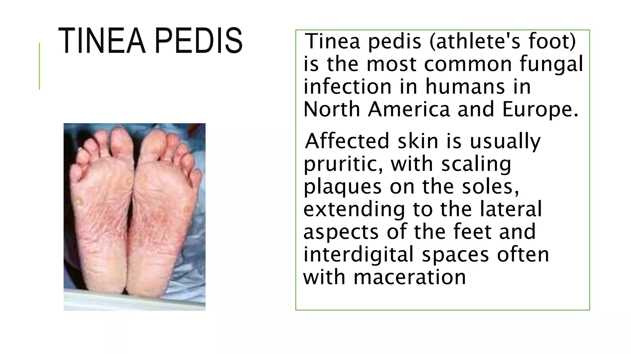 Tinea pedis (athlete's foot)
is the most common fungal
infection in humans in
North America and Europe.
Affected skin is usually
pruritic, with scaling
plaques on the soles,
extending to the lateral
aspects of the feet and
interdigital spaces often
with maceration
TINEA PEDIS
 