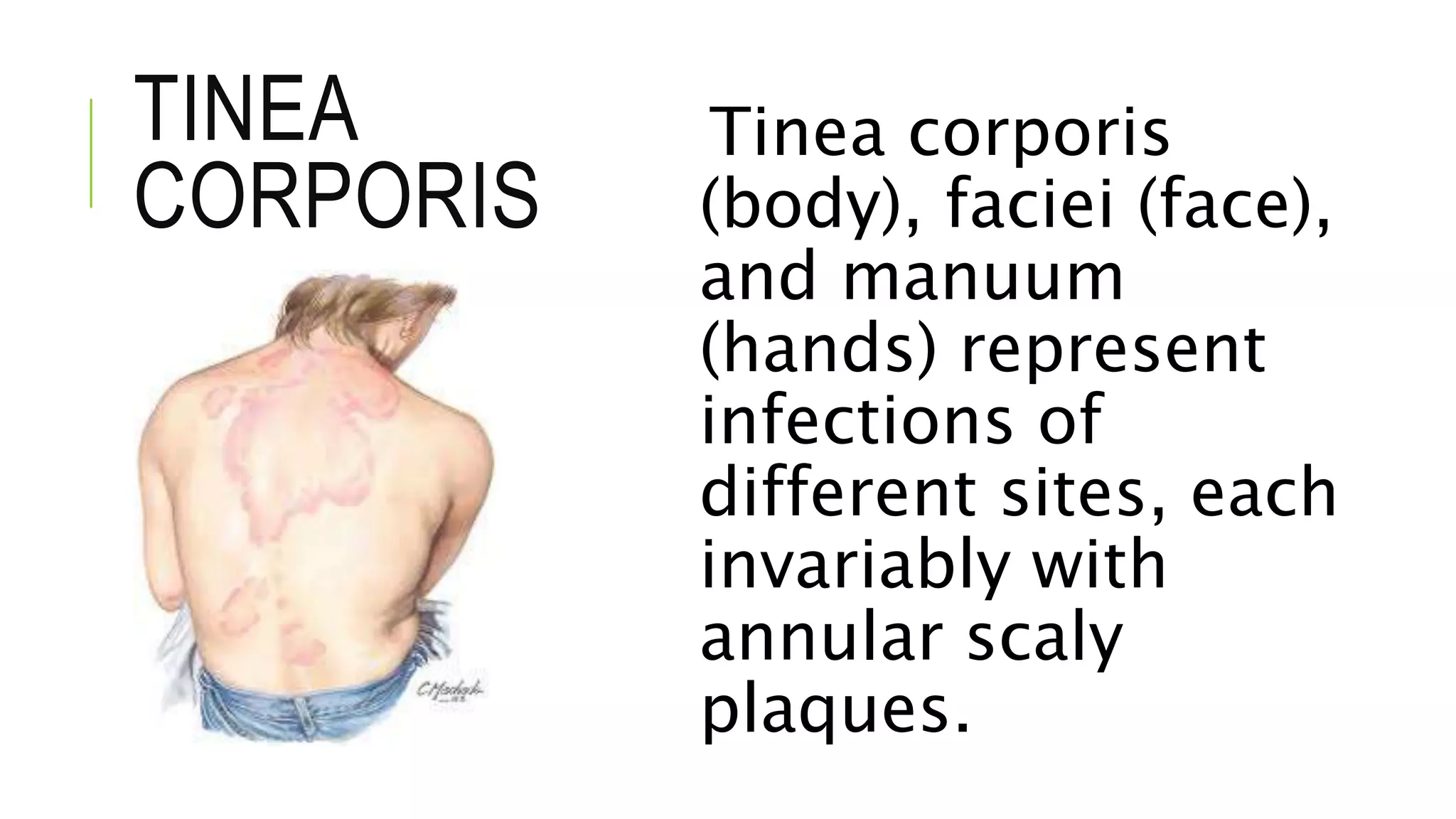TINEA
CORPORIS
Tinea corporis
(body), faciei (face),
and manuum
(hands) represent
infections of
different sites, each
invariably with
annular scaly
plaques.
 