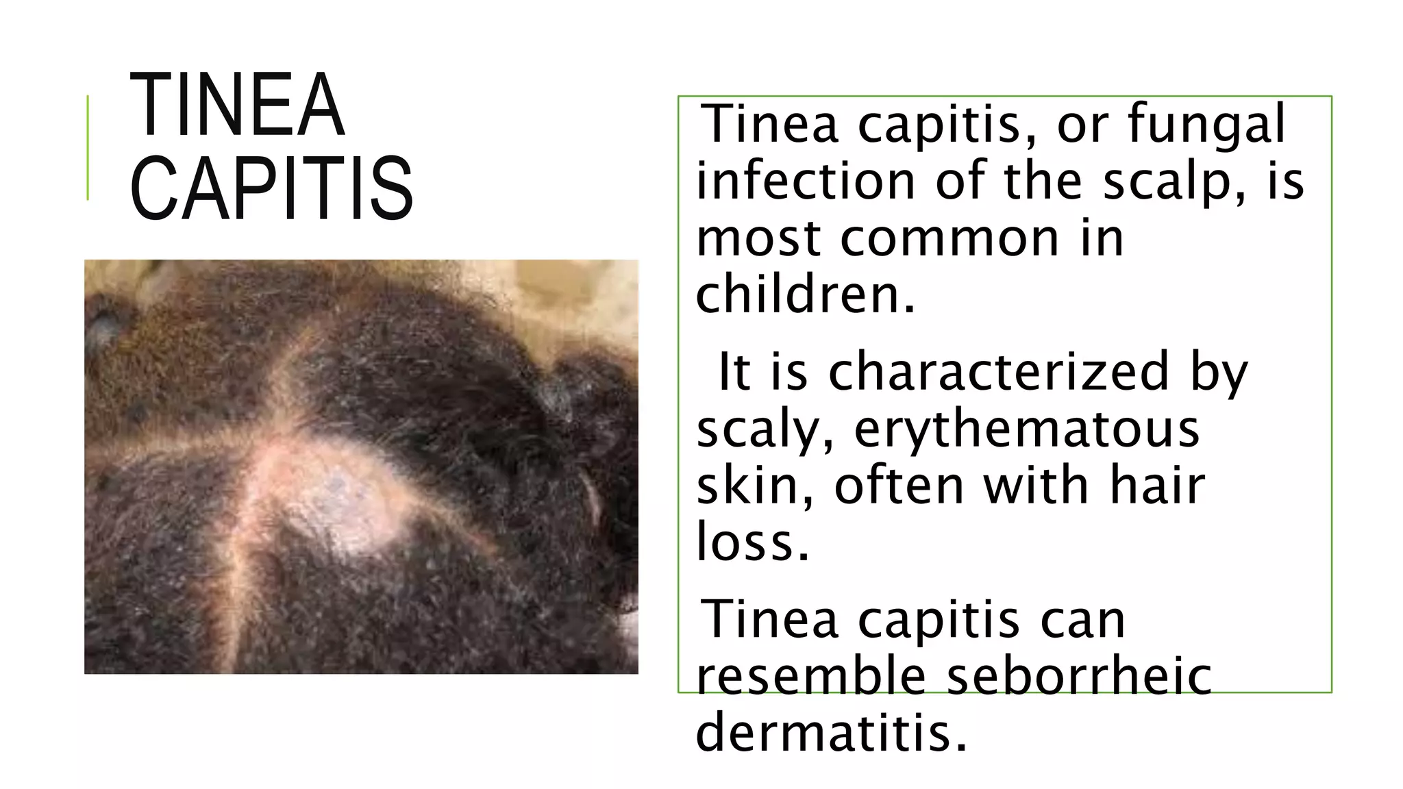 TINEA
CAPITIS
Tinea capitis, or fungal
infection of the scalp, is
most common in
children.
It is characterized by
scaly, erythematous
skin, often with hair
loss.
Tinea capitis can
resemble seborrheic
dermatitis.
 