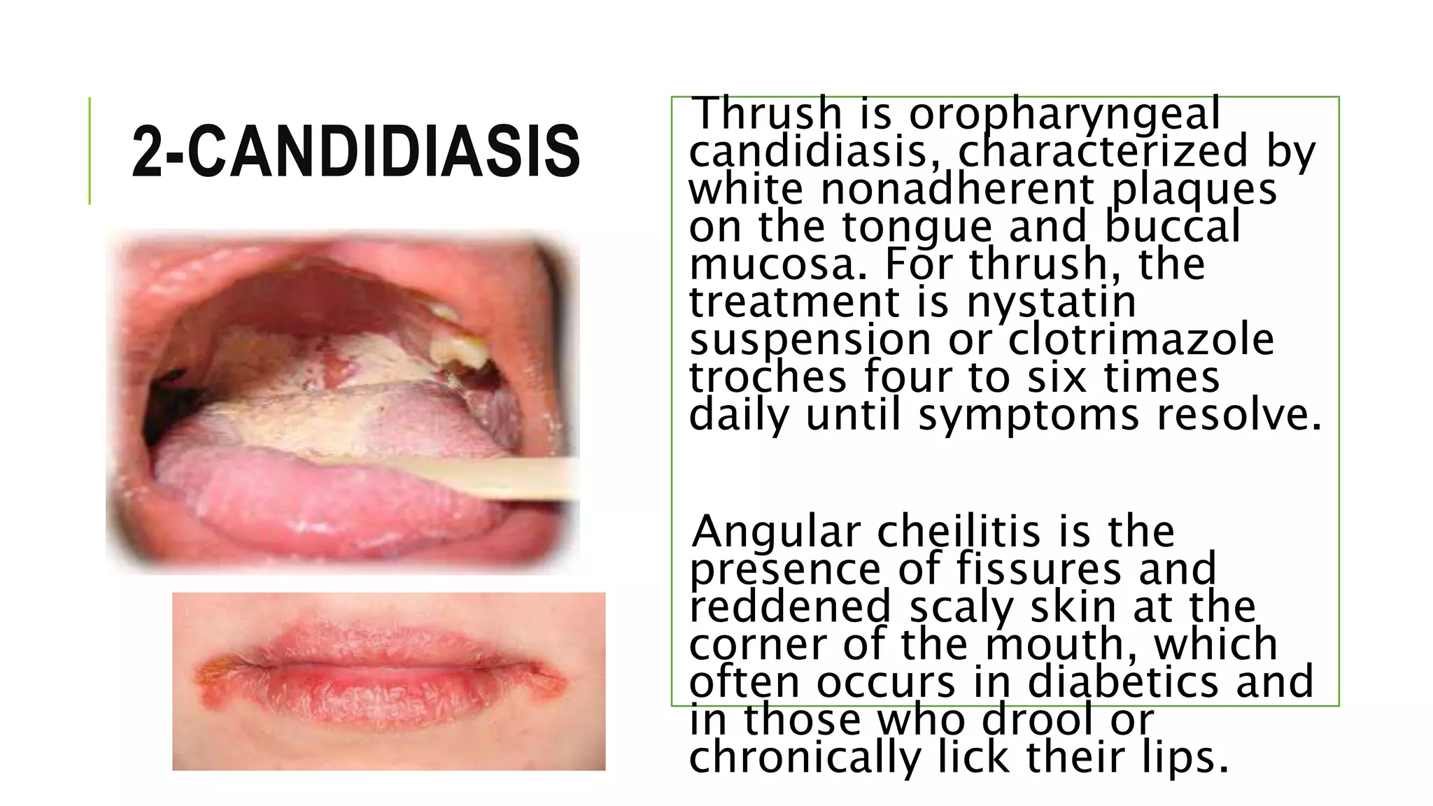 2-CANDIDIASIS
Thrush is oropharyngeal
candidiasis, characterized by
white nonadherent plaques
on the tongue and buccal
mucosa. For thrush, the
treatment is nystatin
suspension or clotrimazole
troches four to six times
daily until symptoms resolve.
Angular cheilitis is the
presence of fissures and
reddened scaly skin at the
corner of the mouth, which
often occurs in diabetics and
in those who drool or
chronically lick their lips.
 