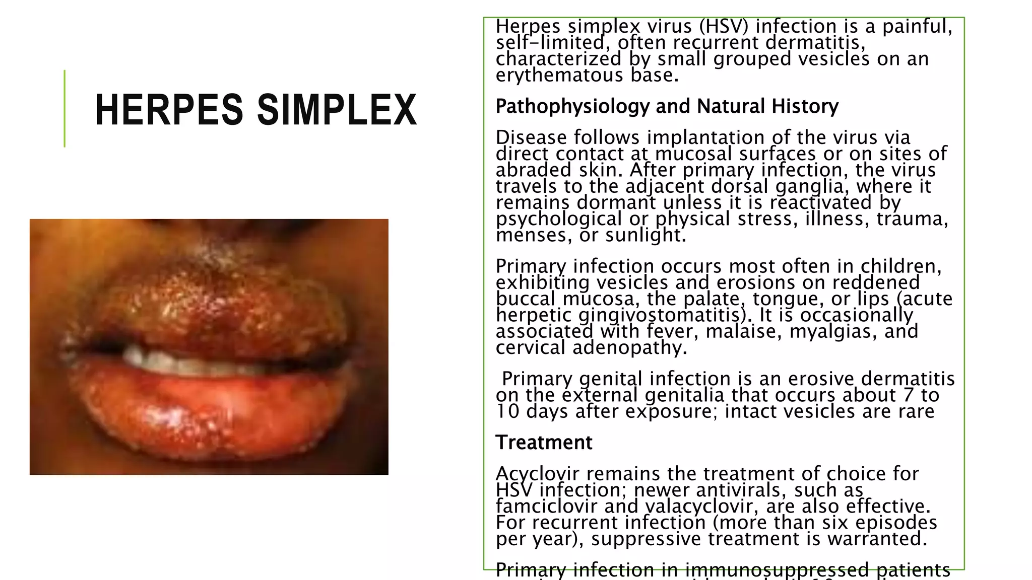 HERPES SIMPLEX
Herpes simplex virus (HSV) infection is a painful,
self-limited, often recurrent dermatitis,
characterized by small grouped vesicles on an
erythematous base.
Pathophysiology and Natural History
Disease follows implantation of the virus via
direct contact at mucosal surfaces or on sites of
abraded skin. After primary infection, the virus
travels to the adjacent dorsal ganglia, where it
remains dormant unless it is reactivated by
psychological or physical stress, illness, trauma,
menses, or sunlight.
Primary infection occurs most often in children,
exhibiting vesicles and erosions on reddened
buccal mucosa, the palate, tongue, or lips (acute
herpetic gingivostomatitis). It is occasionally
associated with fever, malaise, myalgias, and
cervical adenopathy.
Primary genital infection is an erosive dermatitis
on the external genitalia that occurs about 7 to
10 days after exposure; intact vesicles are rare
Treatment
Acyclovir remains the treatment of choice for
HSV infection; newer antivirals, such as
famciclovir and valacyclovir, are also effective.
For recurrent infection (more than six episodes
per year), suppressive treatment is warranted.
Primary infection in immunosuppressed patients
 