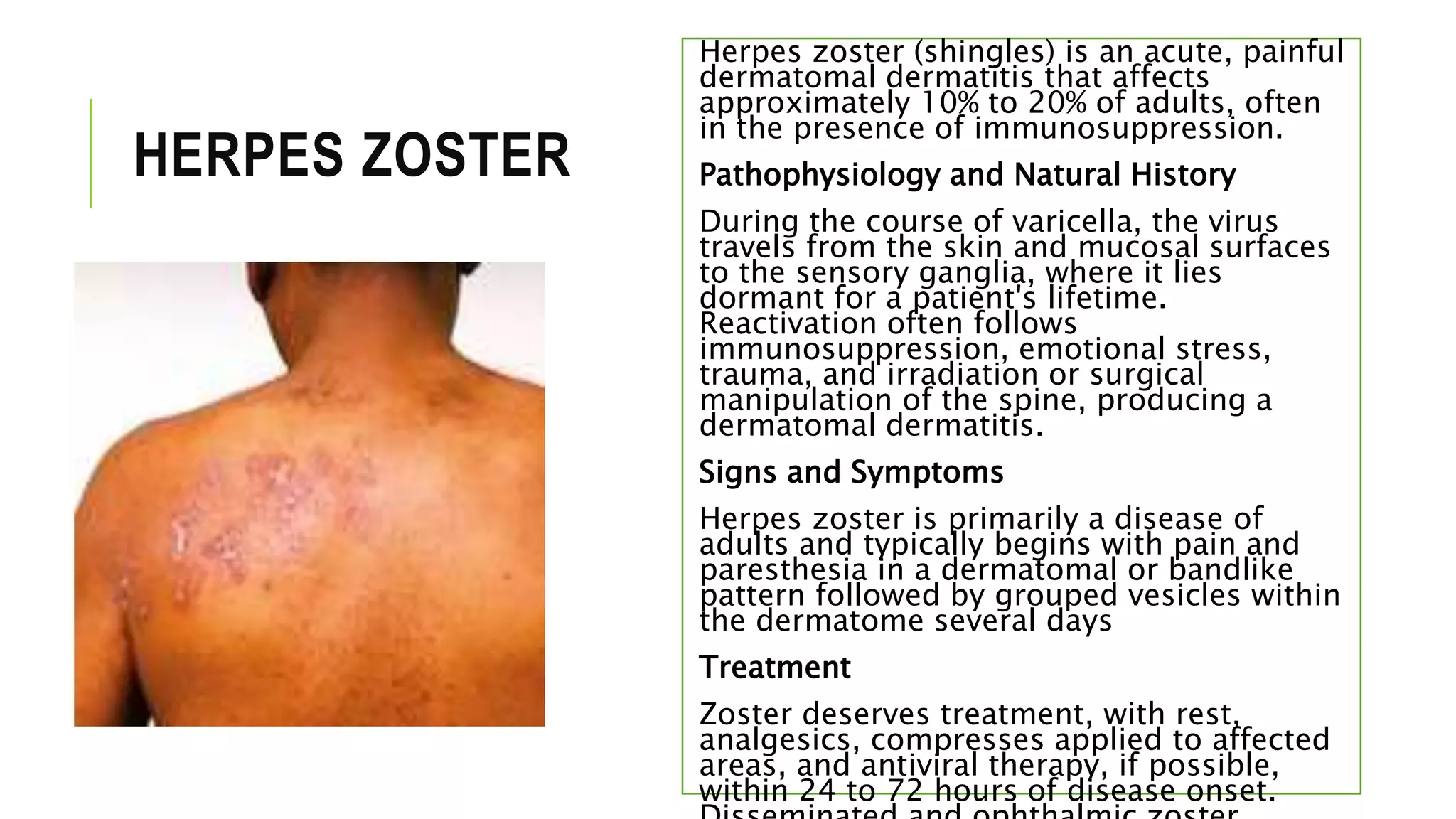 HERPES ZOSTER
Herpes zoster (shingles) is an acute, painful
dermatomal dermatitis that affects
approximately 10% to 20% of adults, often
in the presence of immunosuppression.
Pathophysiology and Natural History
During the course of varicella, the virus
travels from the skin and mucosal surfaces
to the sensory ganglia, where it lies
dormant for a patient's lifetime.
Reactivation often follows
immunosuppression, emotional stress,
trauma, and irradiation or surgical
manipulation of the spine, producing a
dermatomal dermatitis.
Signs and Symptoms
Herpes zoster is primarily a disease of
adults and typically begins with pain and
paresthesia in a dermatomal or bandlike
pattern followed by grouped vesicles within
the dermatome several days
Treatment
Zoster deserves treatment, with rest,
analgesics, compresses applied to affected
areas, and antiviral therapy, if possible,
within 24 to 72 hours of disease onset.
 