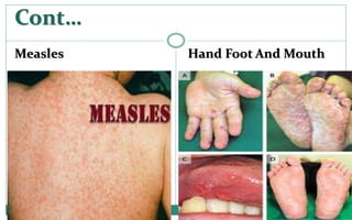Cont…
Measles Hand Foot And Mouth
 