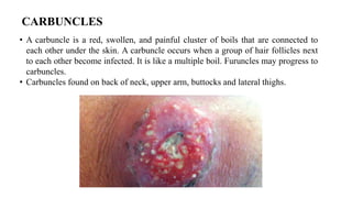 Carvbuncle Back skin infections_121240.pptx