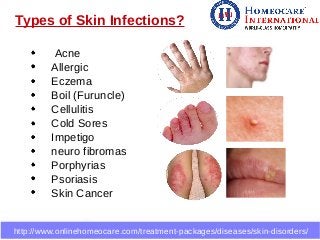 Skin infections cured through homeopathic medicine