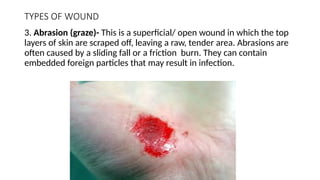 TYPES OF WOUND
3. Abrasion (graze)- This is a superficial/ open wound in which the top
layers of skin are scraped off, leaving a raw, tender area. Abrasions are
often caused by a sliding fall or a friction burn. They can contain
embedded foreign particles that may result in infection.
 