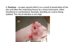 4. Puncture – an open wound which is as a result of penetration of the
skin and often the underlying tissues by a sharp instrument, either
intentional or unintentional. Example. Standing on a nail or being
stabbed. The risk of infection is very high.
 