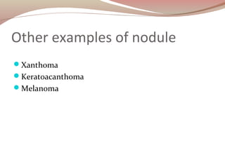 Other examples of nodule
Xanthoma
Keratoacanthoma
Melanoma
 