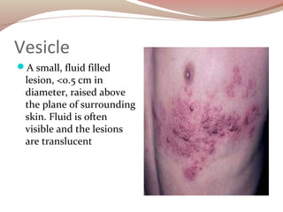 Vesicle
A small, fluid filled
lesion, <0.5 cm in
diameter, raised above
the plane of surrounding
skin. Fluid is often
vis...