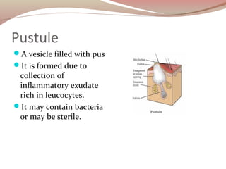 Pustule
A vesicle filled with pus
It is formed due to
collection of
inflammatory exudate
rich in leucocytes.
It may con...