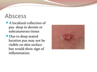 Abscess
A localized collection of
pus deep in dermis or
subcutaneous tissue
Due to deep seated
location pus may not be
v...