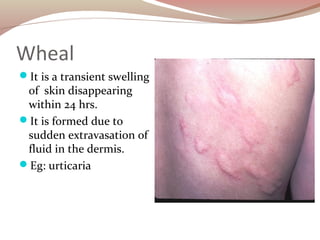 Wheals Examples Skin Wheal