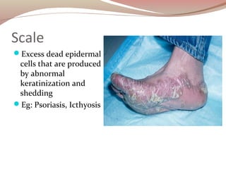 Scale
Excess dead epidermal
cells that are produced
by abnormal
keratinization and
shedding
Eg: Psoriasis, Icthyosis
 