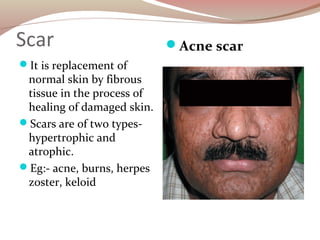 Scar
It is replacement of
normal skin by fibrous
tissue in the process of
healing of damaged skin.
Scars are of two type...