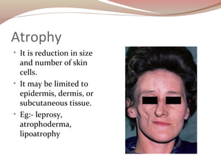 Atrophy
• It is reduction in size
and number of skin
cells.
• It may be limited to
epidermis, dermis, or
subcutaneous tiss...