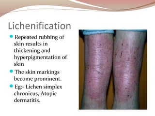 Lichenification
Repeated rubbing of
skin results in
thickening and
hyperpigmentation of
skin
The skin markings
become pr...