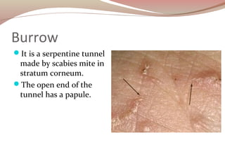 Burrow
It is a serpentine tunnel
made by scabies mite in
stratum corneum.
The open end of the
tunnel has a papule.
 