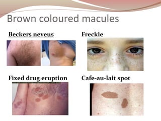 Brown coloured macules
Beckers neveus Freckle
Fixed drug eruption Cafe-au-lait spot
 