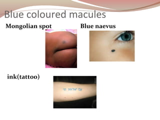 Blue coloured macules
Mongolian spot Blue naevus
ink(tattoo)
 