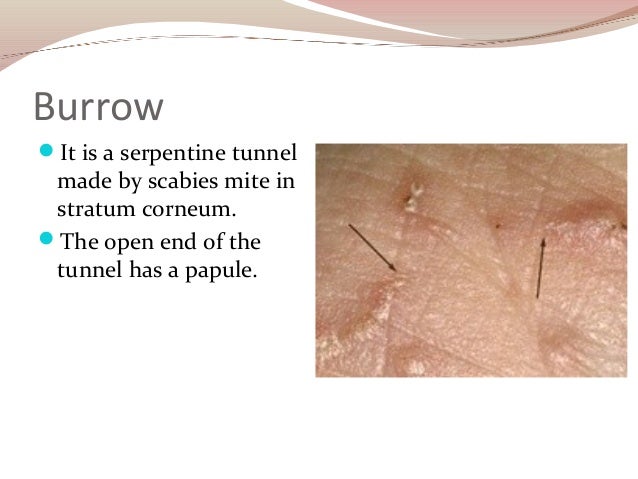 S-Health Topics-Scabies