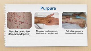 Purpura Rheumatica Skin manifestations in rheumatic diseases | PPTX