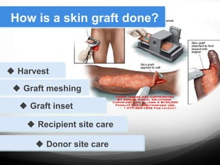 How is a skin graft done?
 Harvest
 Graft meshing
 Graft inset
 Recipient site care
 Donor site care
 