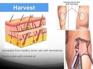  Harvested from healthy donor site with dermatome
 Tension skin with mineral oil
Harvest
 