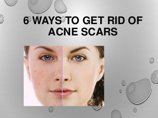 6 WAYS TO GET RID OF
ACNE SCARS
 