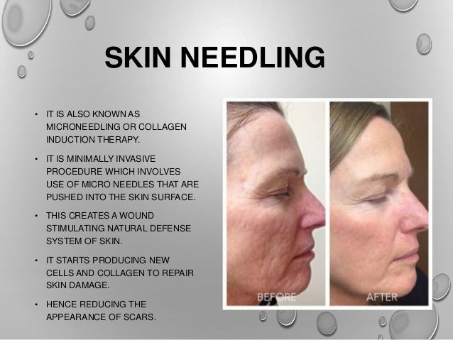 Get rid of old acne scars and check her other recipe to ...
