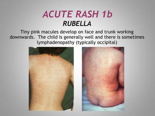 Microbabular Rash skin rash for dermatology field in medical field | PDF