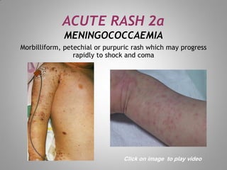 Mmrv Rash Normal skin rash for dermatology field in medical field | PDF