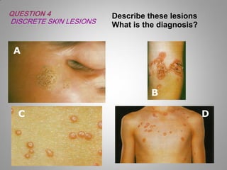 skin rash for dermatology field in medical field | PDF