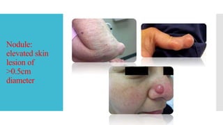 Nodular Inflamed Rash Skin rashes red flag symptoms | PPTX