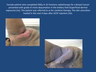 Female patient who completed 50Gy in 25 fractions radiotherapy for a Breast Cancer
presented with grade III moist dequmation in the Axillary fold (Superficial dermal
exposure) (1a). The patient was referred to us for cytokine therapy. The skin ulceration
healed in the next 4 days after GCSF injection (1b).
 