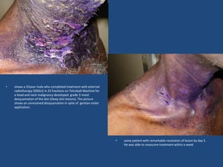 • shows a 55year male who completed treatment with external
radiotherapy 5000cG in 25 fractions on Telcobalt Machine for
a head and neck malignancy developed grade 3 moist
desquamation of the skin (Deep skin lesions). The picture
shows an unresolved desquamation in spite of gentian violet
application.
• same patient with remarkable resolution of lesion by day 5.
He was able to reassume treatment within a week
 
